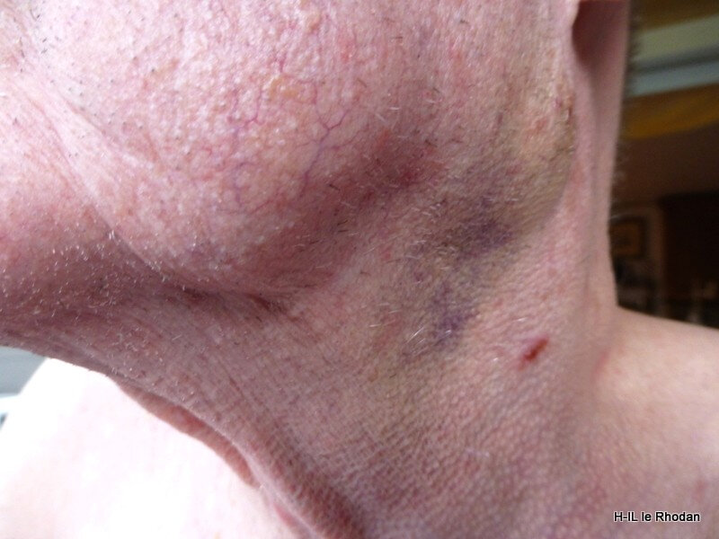 Ganglion sous maxillaire G (2)